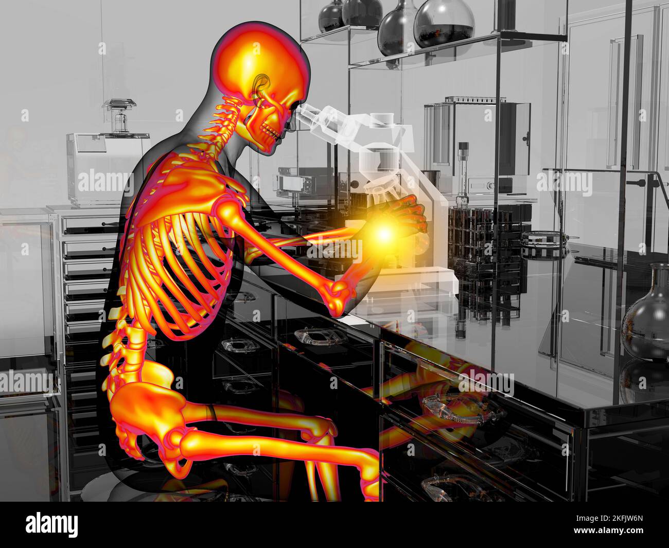 Syndrome du canal carpien chez les travailleurs de laboratoire, illustration Banque D'Images