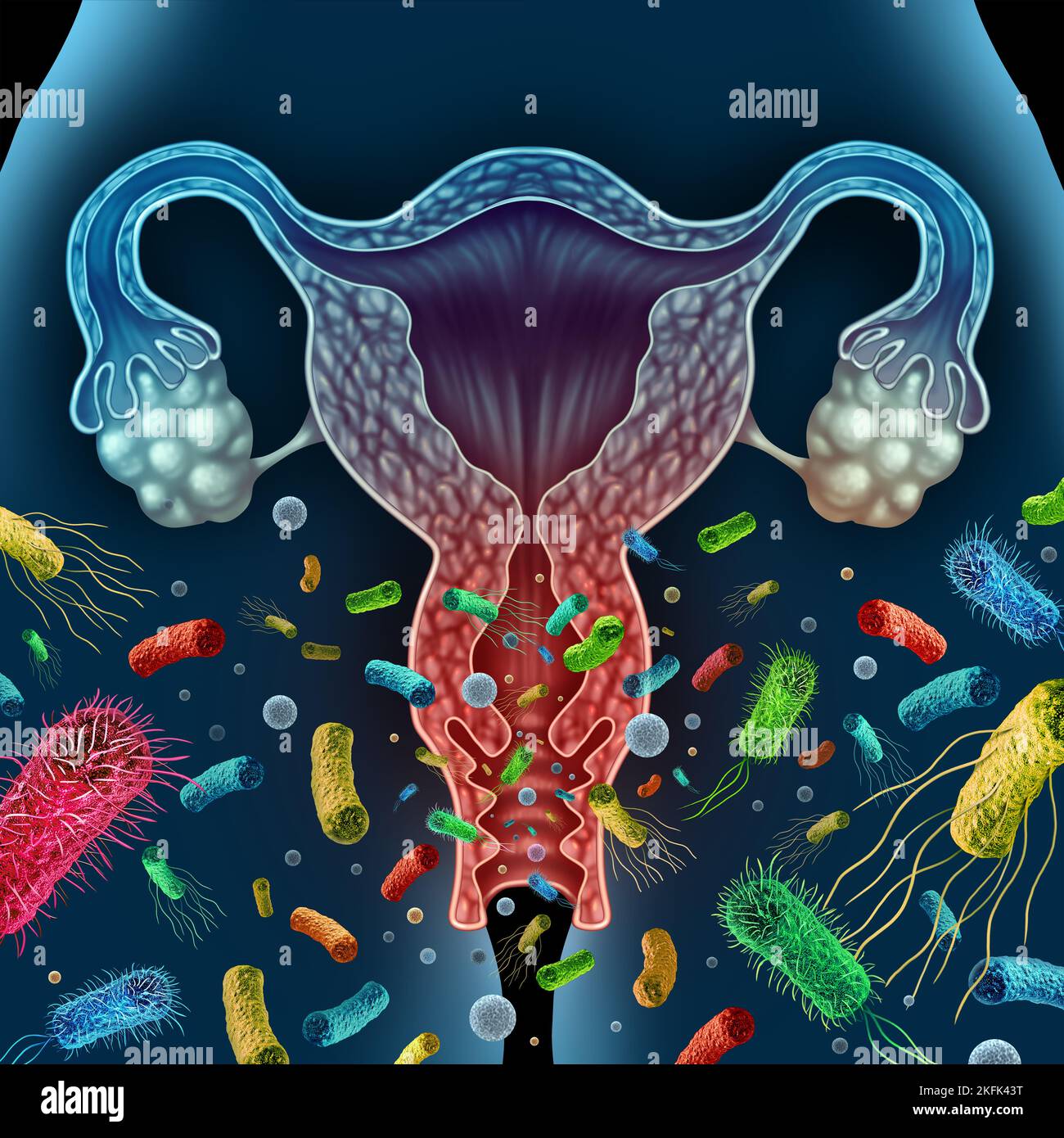 Vaginose bactérienne concept comme une inflammation vaginale causée par une infection bactérienne dans le vagin Banque D'Images