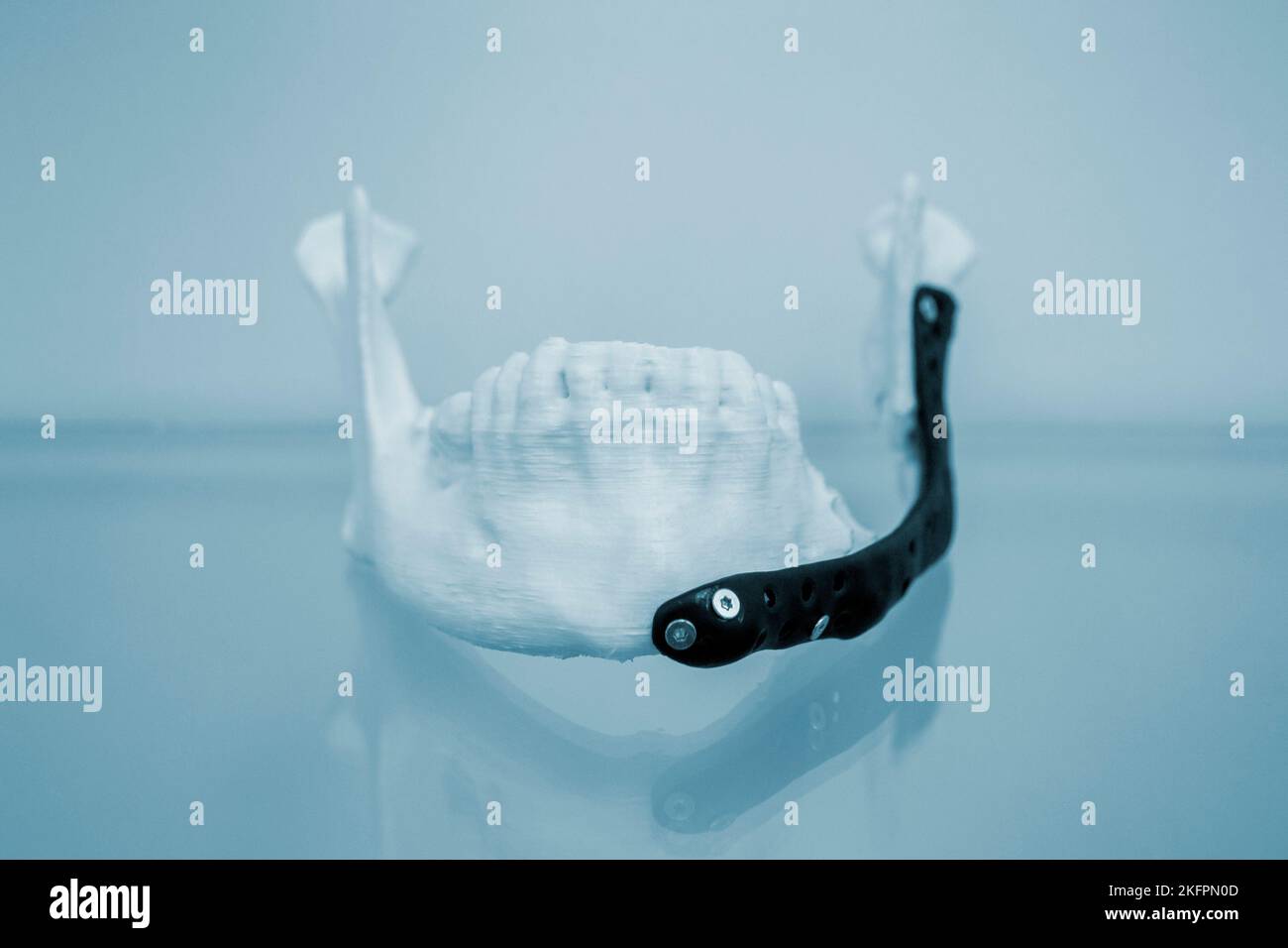 3D prototype de mâchoire inférieure humaine en plastique imprimé et gros plan sur l'implant médical en titane. Prothèse noire prototype anatomique d'os humain 3D imprimé à partir de poudre métallique. Prothèse orthopédique maxillo-faciale Banque D'Images