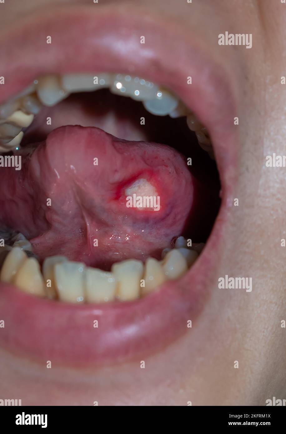 Ulcère à la langue d'un patient asiatique mâle. Le diagnostic peut être un ulcère aphteux, un mal de chancre, un ulcère de stress ou un cancer de la langue. Banque D'Images