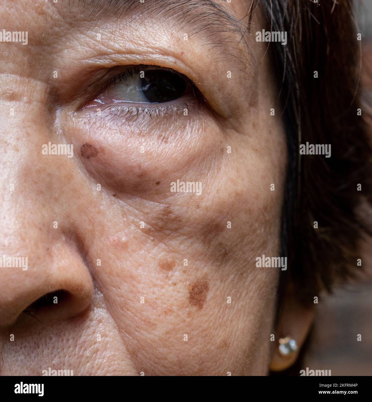 De petites taches brunes appelées taches d'âge sur le visage de la femme asiatique aînée. Ils sont également appelés taches de foie, lentilles séniles, ou taches de soleil. Vue en gros plan. Banque D'Images