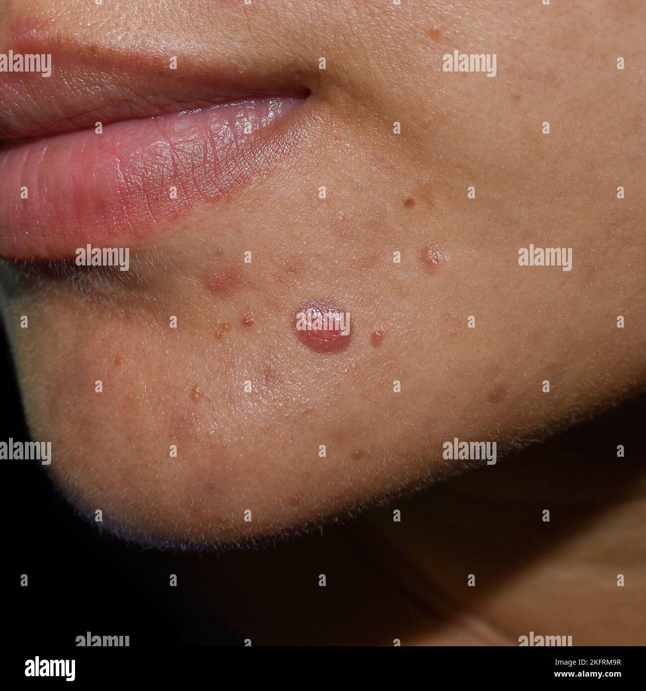 Acné cystique, boutons, taches noires et cicatrices sur le visage huileux de la jeune femme asiatique. Banque D'Images