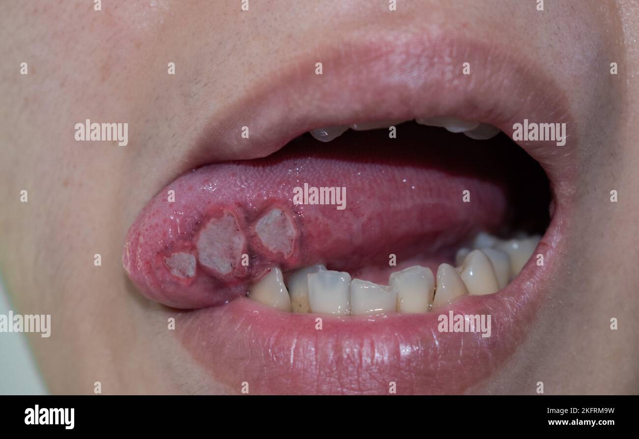 Ulcères à la langue d'un patient asiatique mâle. Le diagnostic peut être un ulcère aphteux, un mal de chancre, un ulcère de stress ou un cancer de la langue. Banque D'Images