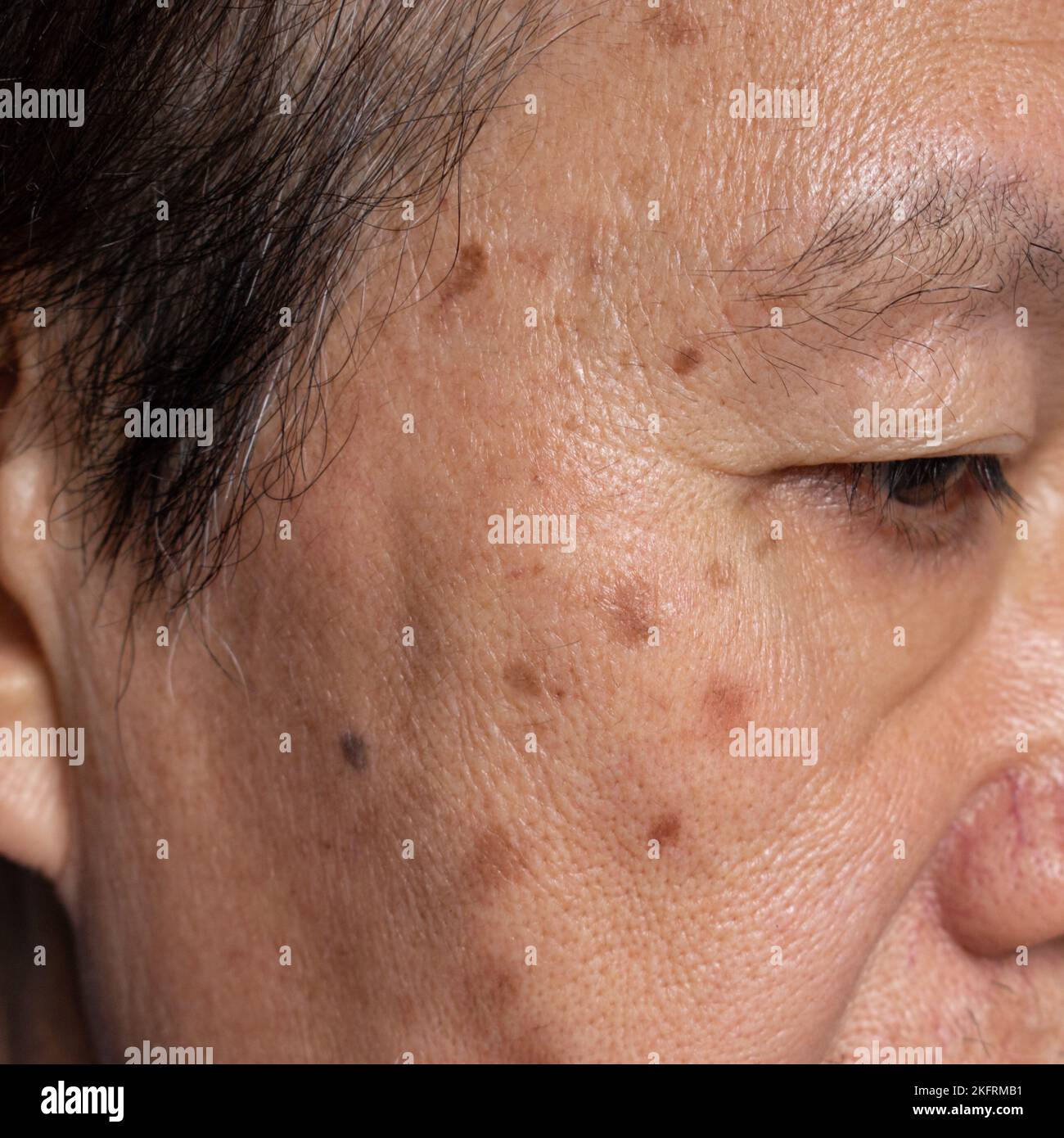 De petites taches brunes appelées taches d'âge sur le visage de l'homme asiatique aîné. Ils sont également appelés taches de foie, lentilles séniles, ou taches de soleil. Vue en gros plan. Banque D'Images