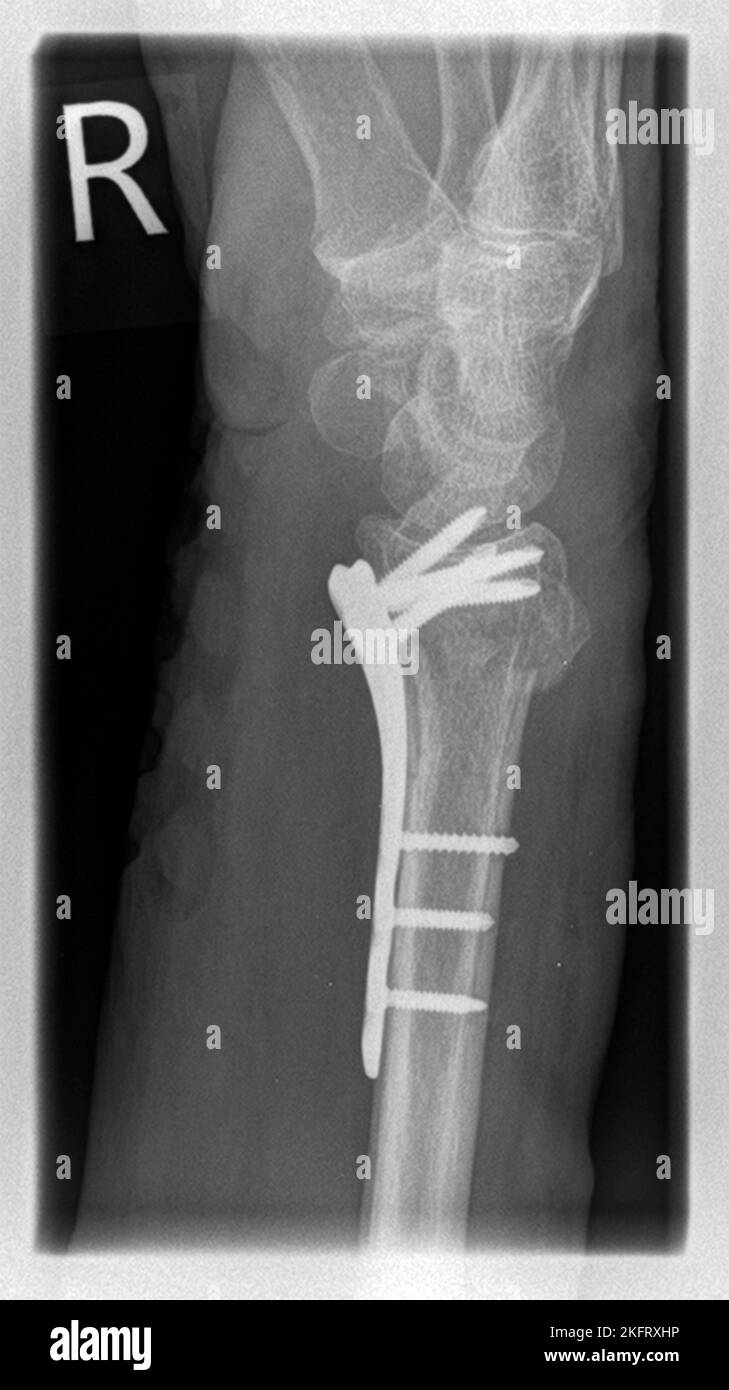 Rayons X d'un patient présentant une fracture de l'extension radiale distale à droite avec avulsion de l'unité d'alimentation, stabilisés par ostéosynthèse de la plaque avec plat angulaire stable Banque D'Images