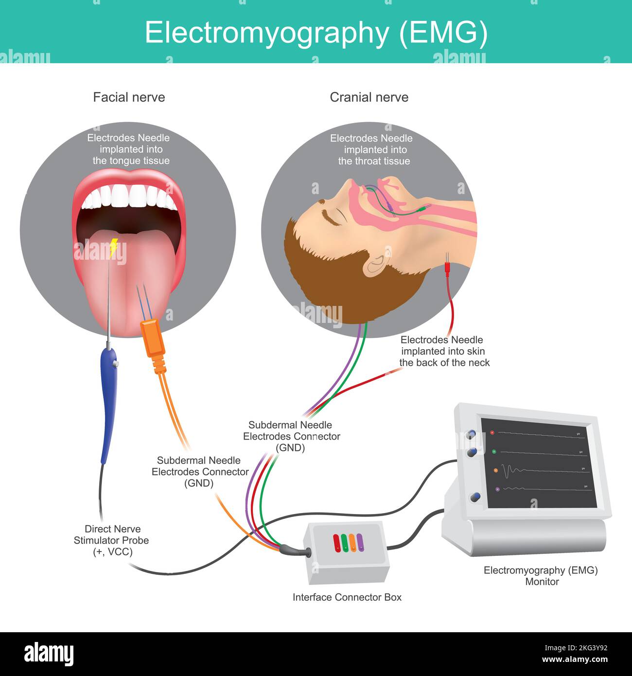 Électromyographie. Technique à usage médical pour évaluer et enregistrer l'activité électrique produite par les muscles. Illustration de Vecteur