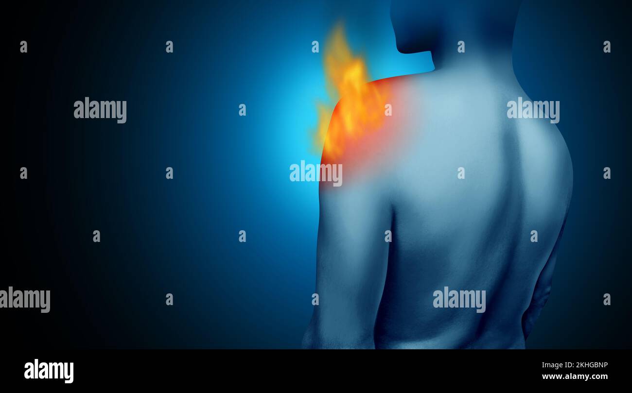 Douleur brûlante à l'épaule et douleur douloureuse à l'articulation de la coiffe des rotateurs et blessure au tendon comme douleur brûlante chronique inflammation due à une blessure ou à un accident de travail Banque D'Images