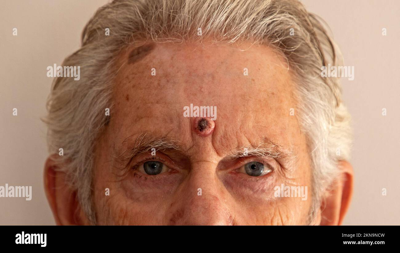 Kératoacanthome croissance du cancer de la peau sur un front mâle. Le kératoacanthome est une tumeur de la peau en forme de dôme de 1 à 2 cm de bas grade et à croissance rapide. Banque D'Images