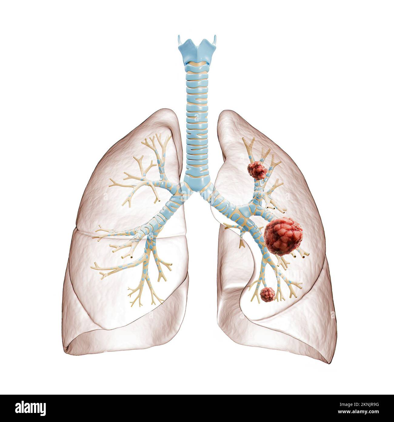 Illustration du cancer du poumon ou du carcinome 3D. Arbre bronchique et poumons infectés par des cellules cancéreuses sur fond blanc. Médical, santé, oncolo Banque D'Images