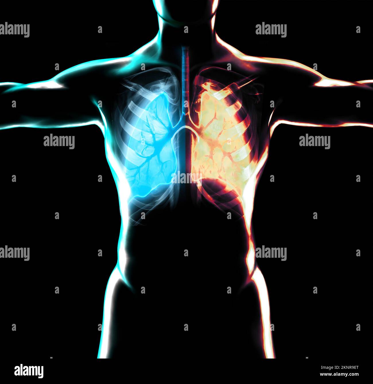 Anatomie humaine, problèmes avec le système respiratoire, poumons gravement endommagés. Pneumonie bilatérale. Covid-19, coronavirus. Patient et fumée. Fumeur Banque D'Images