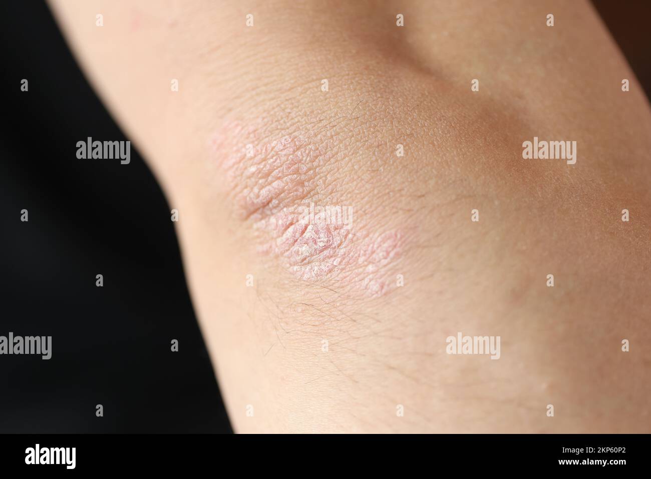 Plaques de psoriasis sur le coude du patient présentant une maladie de ...