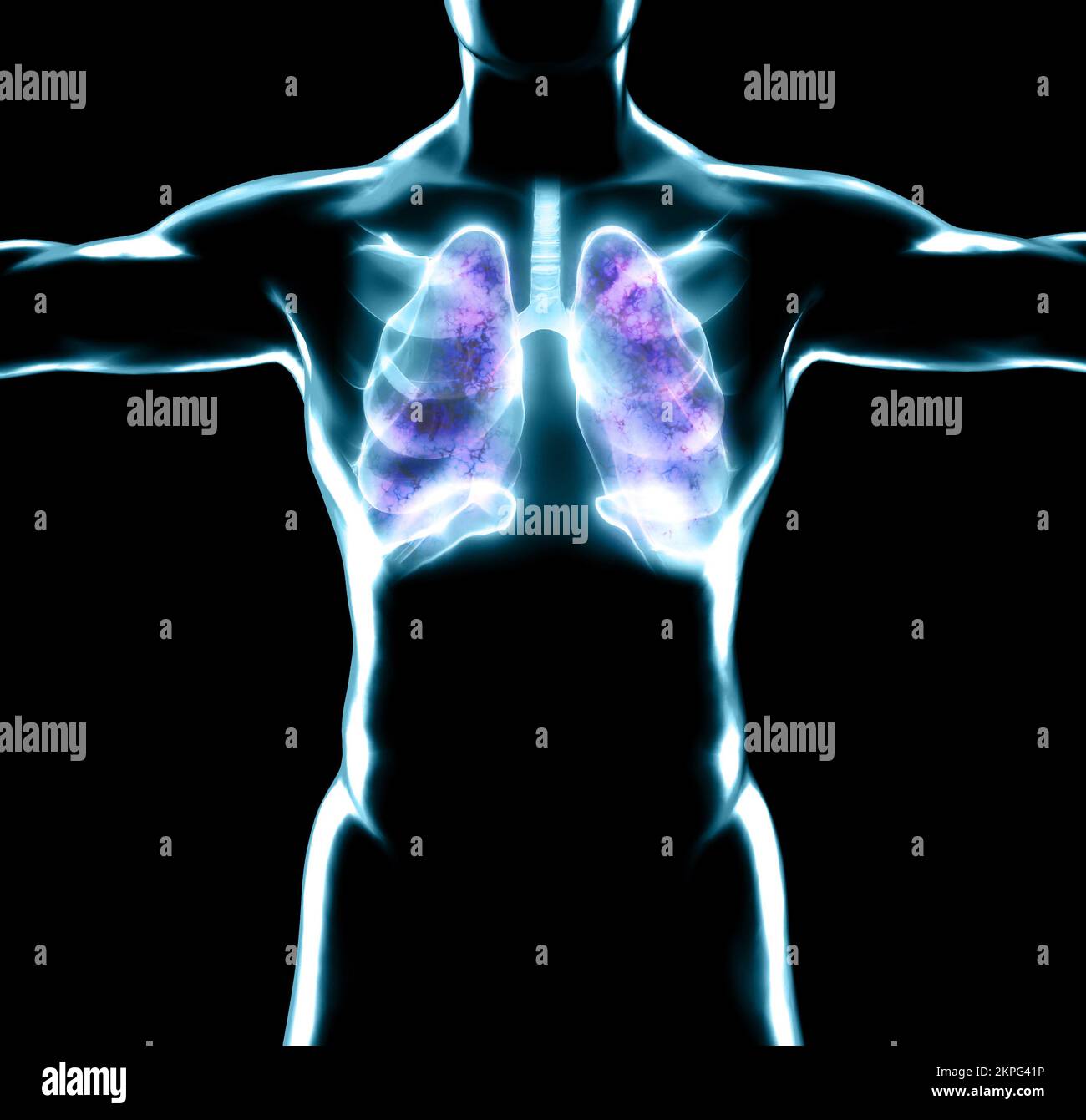 Anatomie humaine, problèmes avec le système respiratoire, poumons gravement endommagés. Pneumonie bilatérale. Covid-19, coronavirus. Patient et fumée. Fumeur Banque D'Images