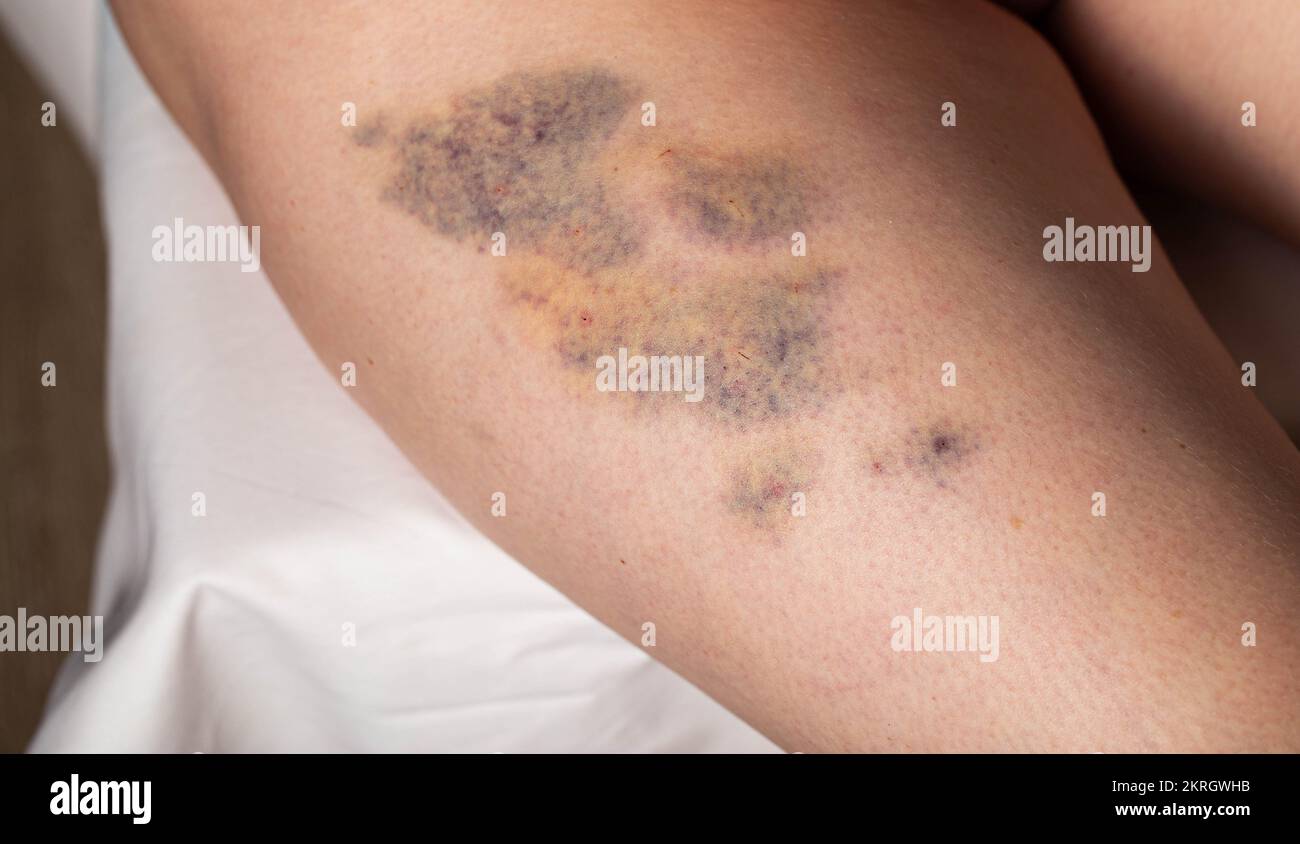 Ecchymoses sur la jambe d'une patiente après un massage thérapeutique, gros plan. Hématome Banque D'Images