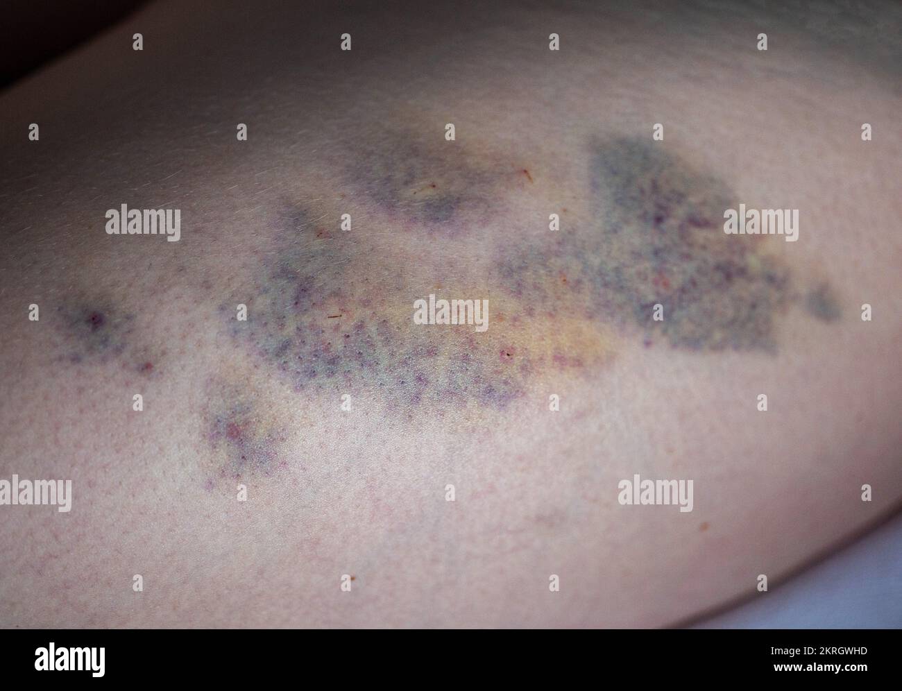 Ecchymoses sur la peau de la jambe du patient après des injections intramusculaires du médicament. Traitement des joints et des ecchymoses après injections, gros plan Banque D'Images