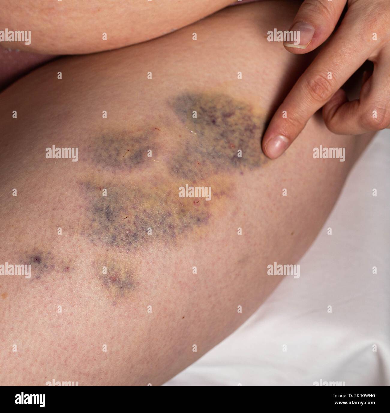 Traitement des ecchymoses, des bosses et des joints après injections avec pommade thérapeutique. Frottement d'une pommade médicinale dans les sites d'injection et d'ecchymoses. Banque D'Images