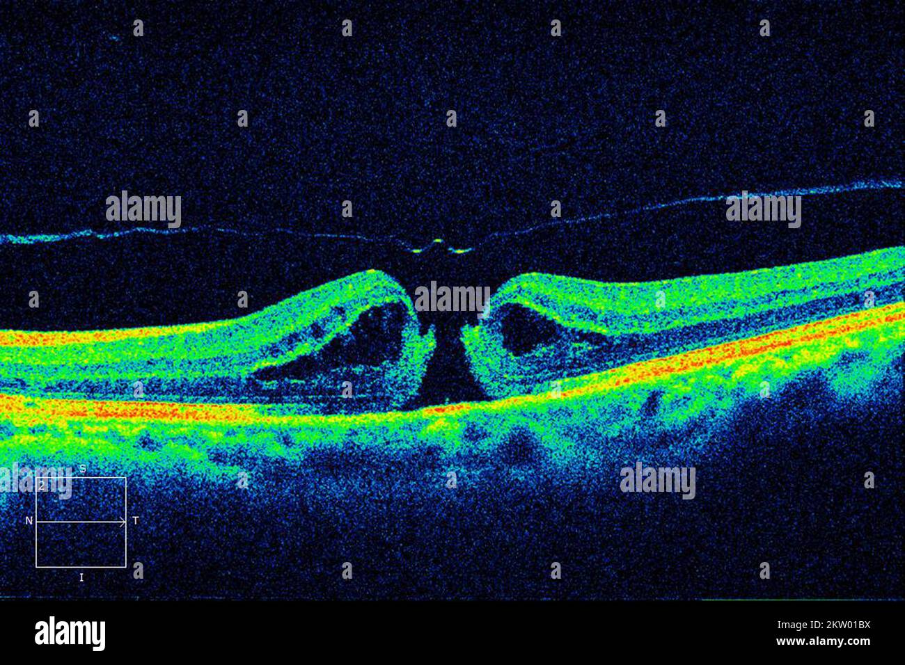 Trou maculaire lamellaire, acquisition OCT Banque D'Images