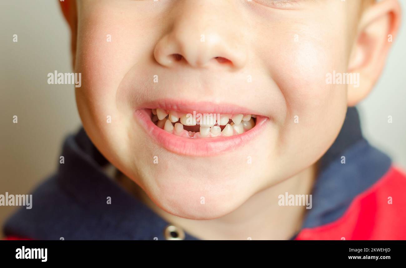 Un garçon de 5 ans a perdu son incisive inférieure. Le sourire d'un enfant sans dent avant Banque D'Images