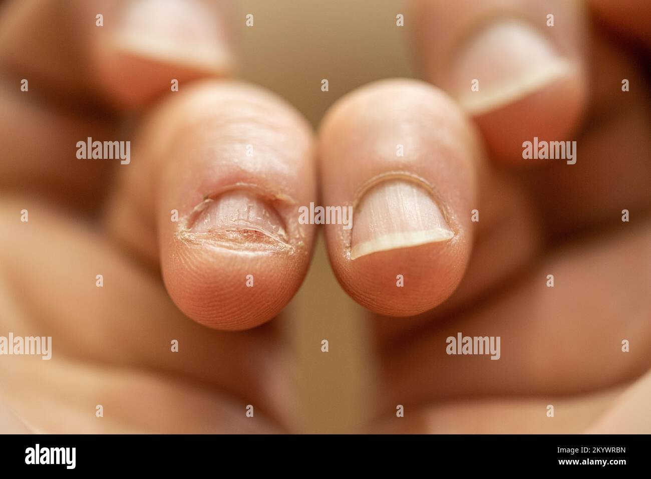 Onychophagy. Gros plan des doigts avec l'ongle mangé. Anxiété et nerfs. Banque D'Images