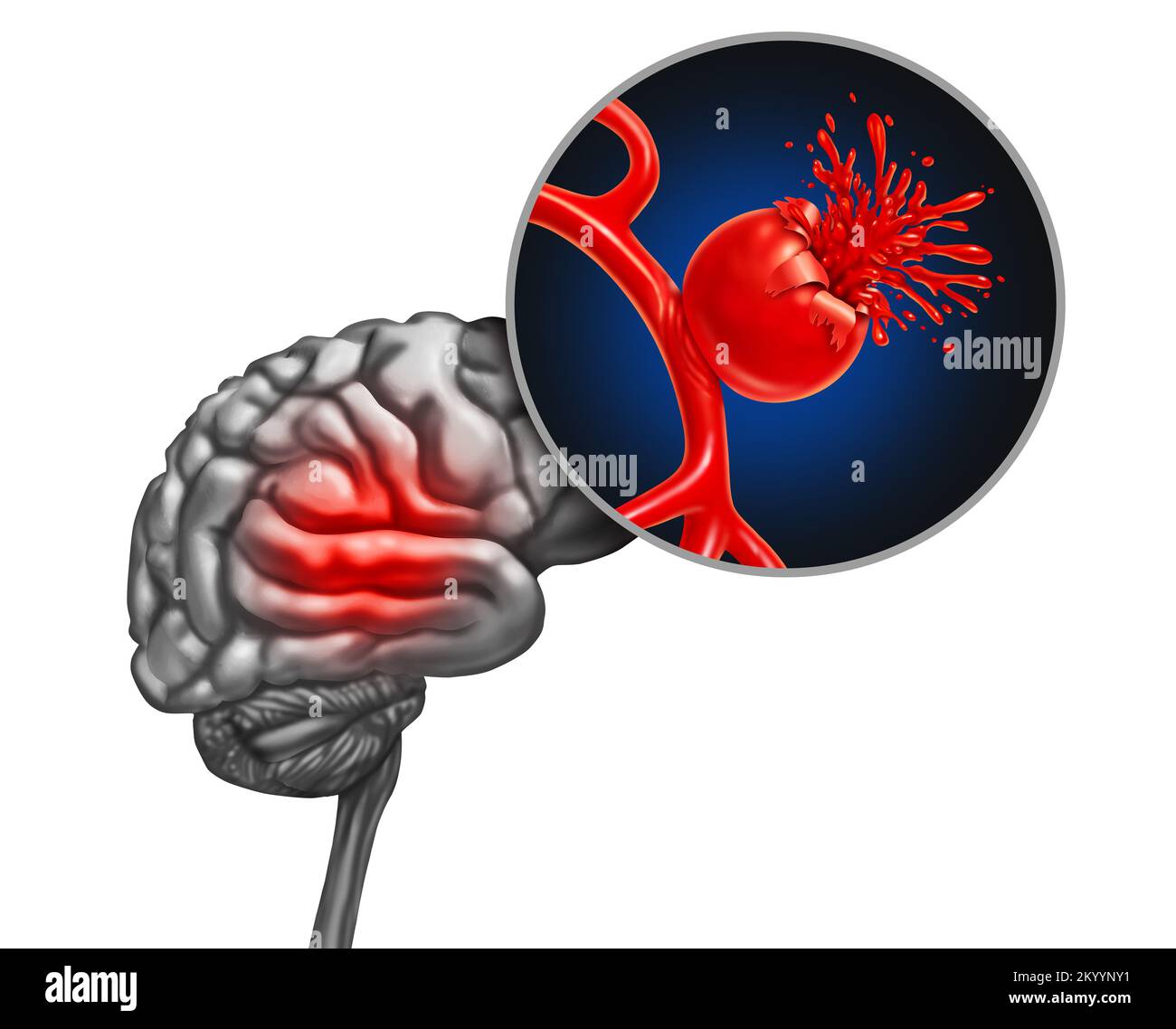 Rupture de l'anévrisme cérébral comme concept médical avec un vaisseau sanguin bombement comme artère de gonflement avec une rupture saignant le sang et causant un risque Banque D'Images