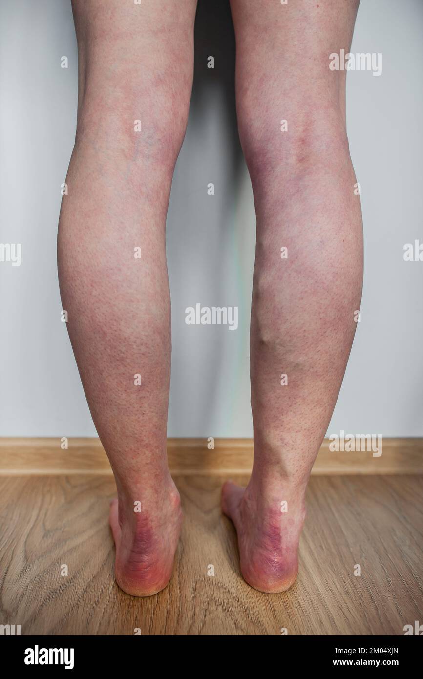 Vue arrière photo d'une personne debout avec pied plat et varices dans une jambe avec veines bombantes tordues visibles sous la peau Banque D'Images