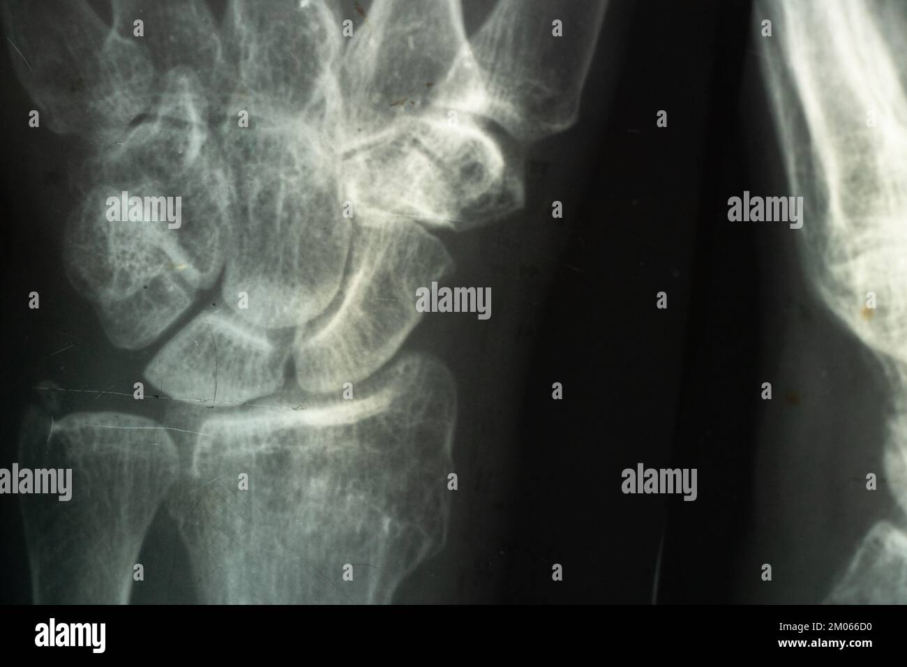 Radiographie d'une personne âgée atteinte d'ostéoporose et d'arthrite arthrose, destruction osseuse, diagnostic et traitement Banque D'Images