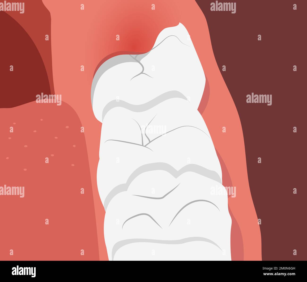 Illustration de la rangée de dents avec la gomme enflammée sur la dent de sagesse croissante. Illustration de Vecteur