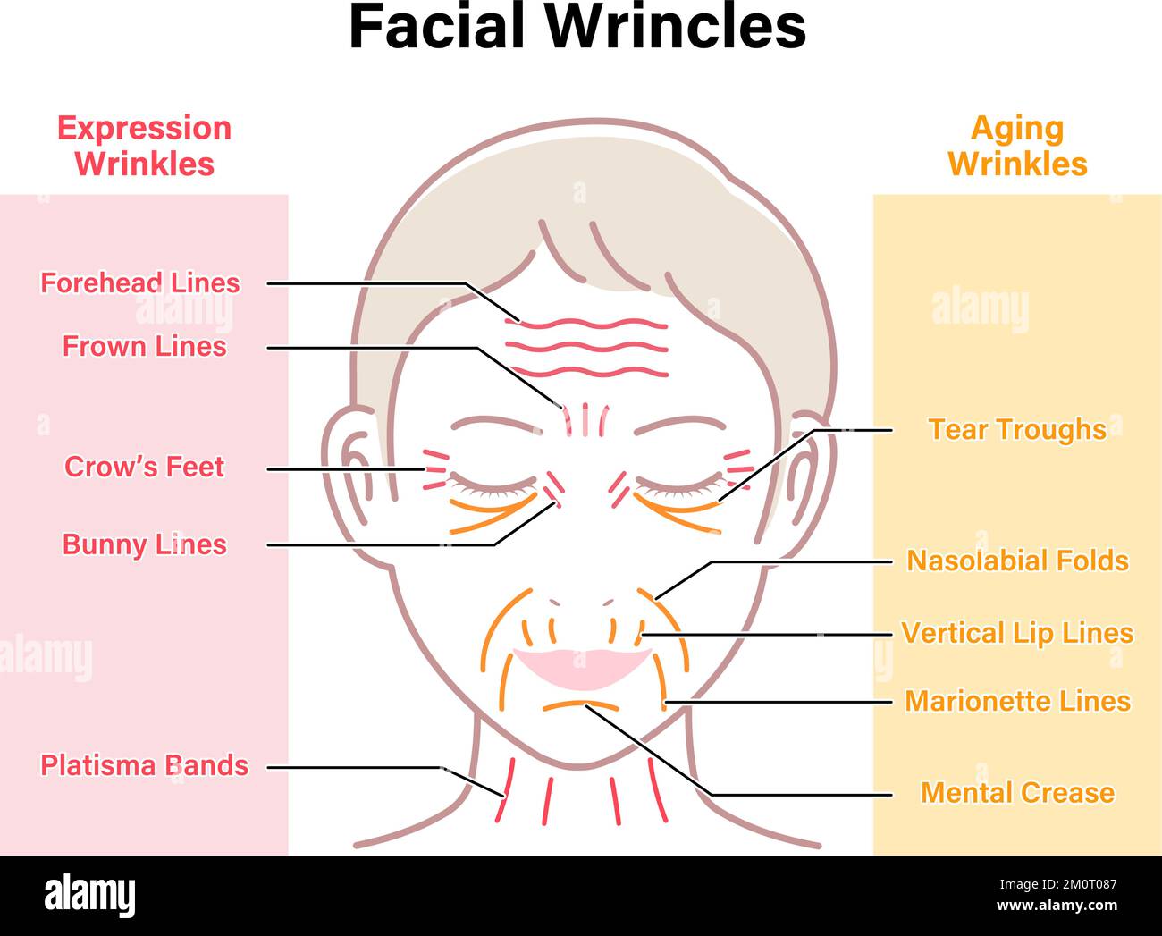 Rides d'expression et rides de vieillissement ( visage féminin ) illustration vectorielle Illustration de Vecteur