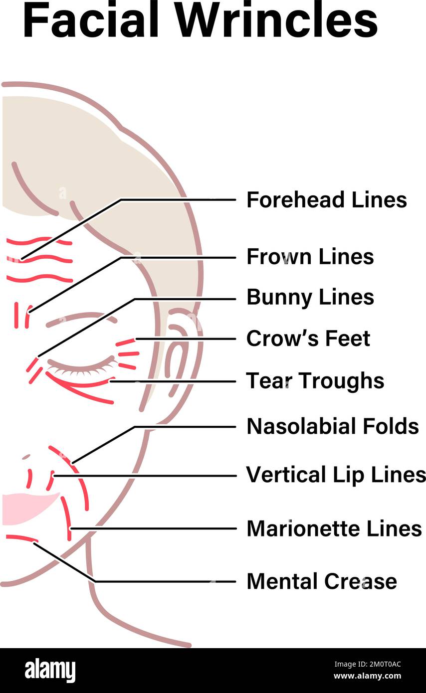 Illustration vectorielle des rides faciales ( visage féminin ) Illustration de Vecteur