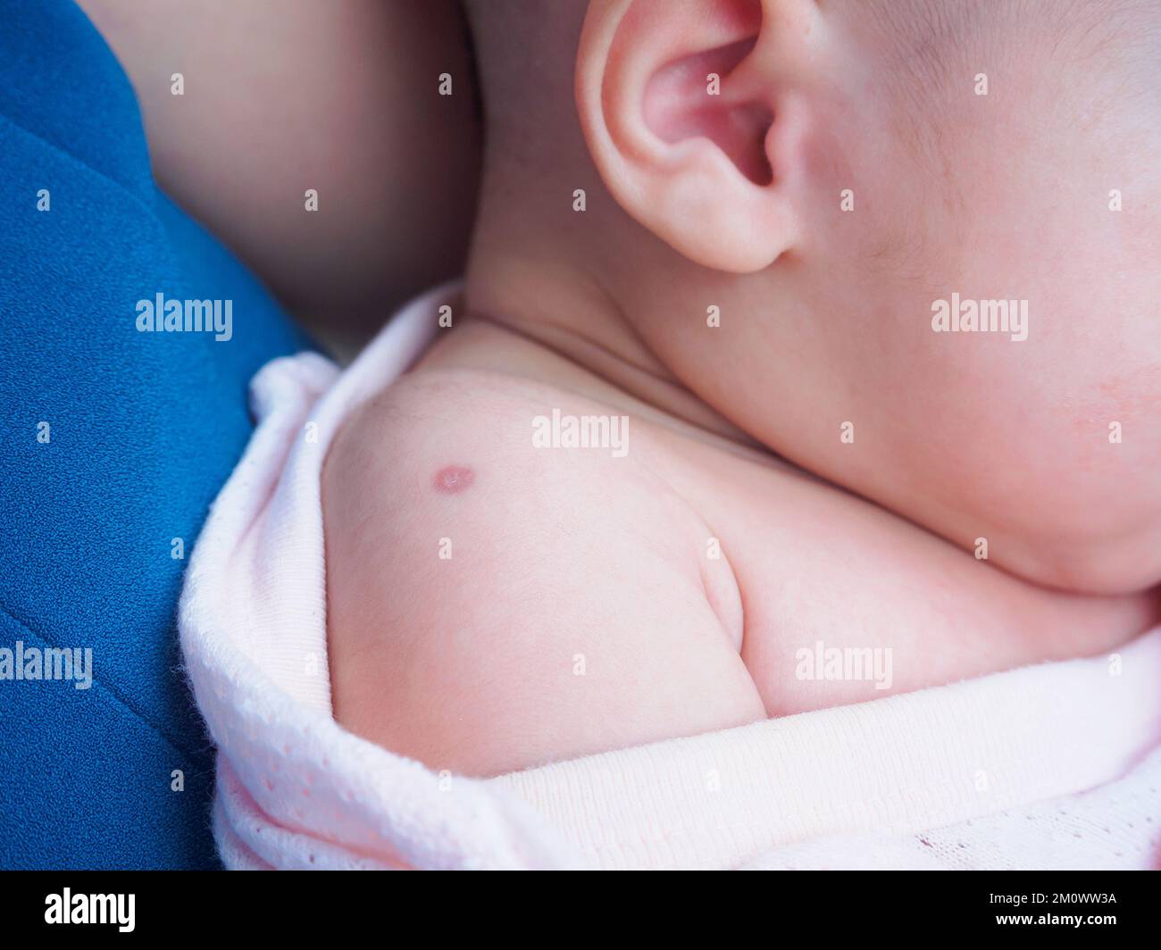 Réaction de vaccination du vaccin BCG de Bacillus Calmette Guérin sur l'épaule du nouveau-né, utilisé contre la tuberculose Banque D'Images