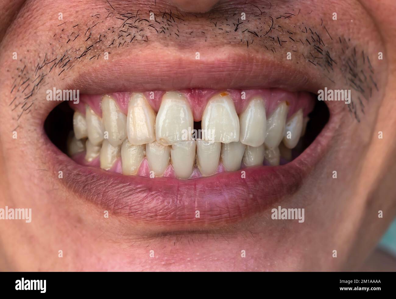 Énorme écart entre les dents ou incisives de l'homme asiatique chinois. Diastema. Banque D'Images
