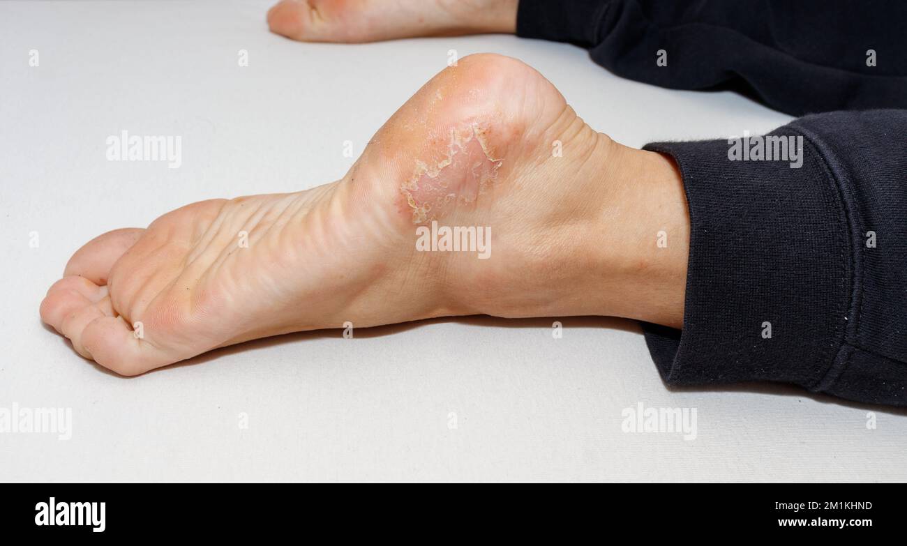 Eczéma dyshidrotique maladie de la peau sur le talon du pied contre fond blanc. Banque D'Images