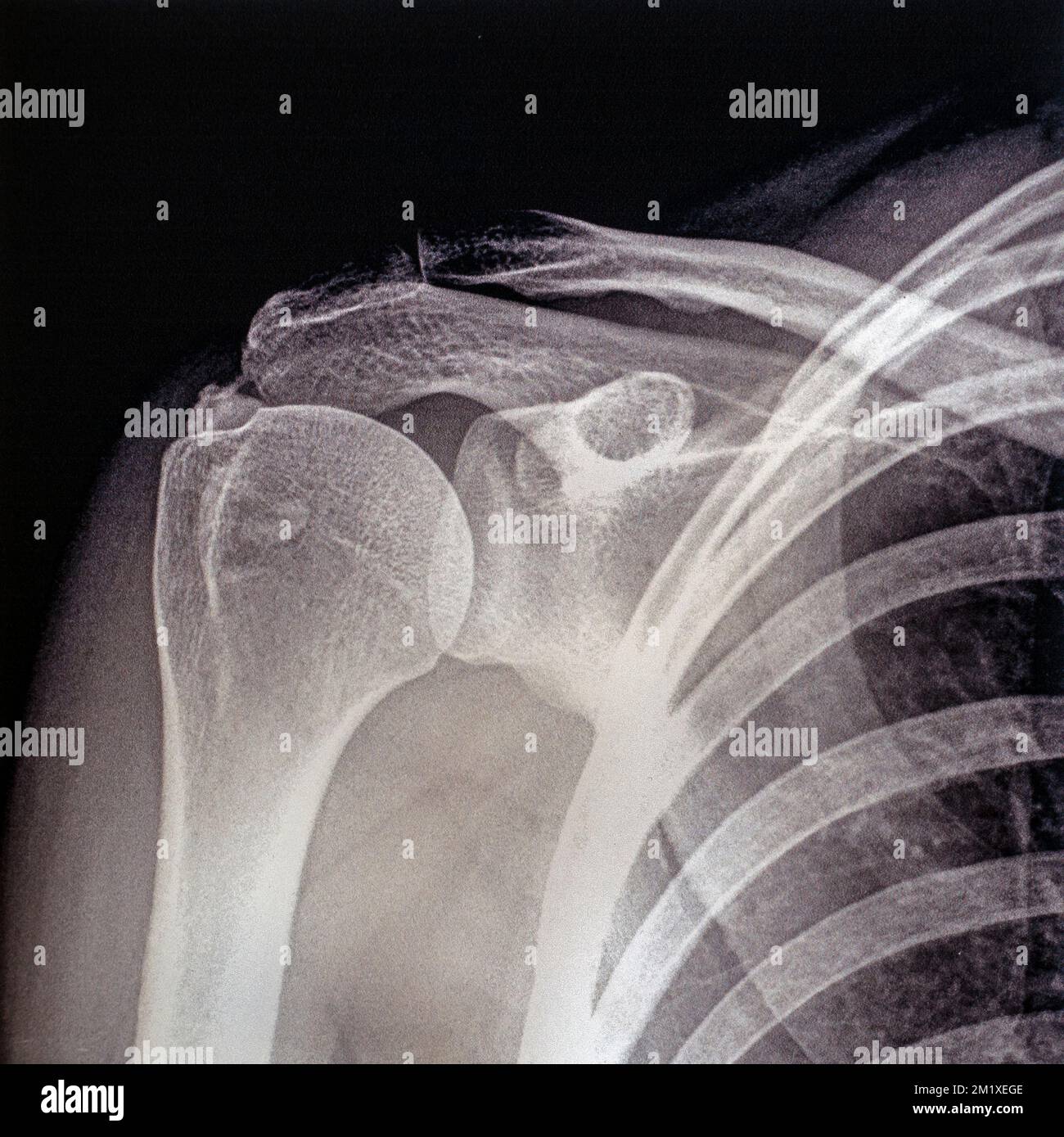 Photographie / radiographie ancienne du milieu du 20th siècle montrant tendinite / tendinopathie de l'épaule, inflammation des tendons Banque D'Images