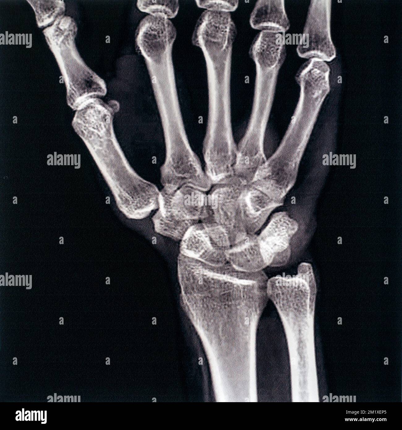 Photographie / radiographie du milieu du 20th siècle montrant le syndrome de Quervain, dégénérescence mucoïde de deux tendons qui contrôlent le mouvement du pouce Banque D'Images