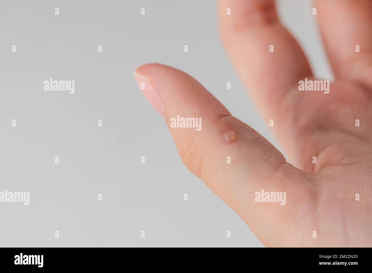 Excroissance sur la peau Banque de photographies et d’images à haute résolution Alamy