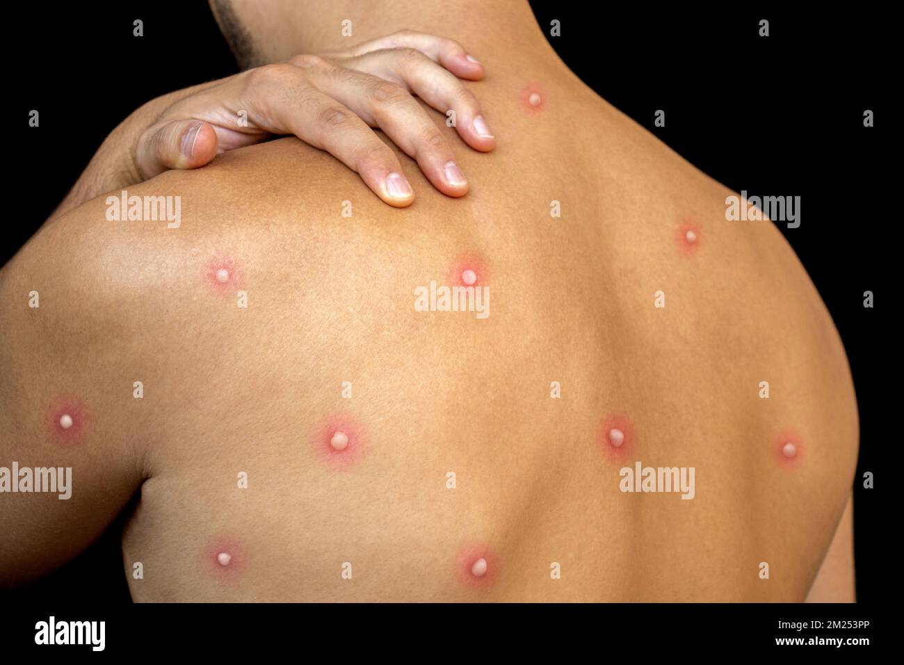 Homme affecté par la nouvelle varicelle maladie dangereuse sur son dos avec des éruptions douloureuses et des cloques . Personne avec des taches rouges de démangeaisons sur la peau avec singe petit Banque D'Images Homme affecté par la nouvelle varicelle maladie dangereuse sur son dos avec des éruptions douloureuses et des cloques . Personne avec des taches rouges de démangeaisons sur la peau avec singe petit Banque D'Images
