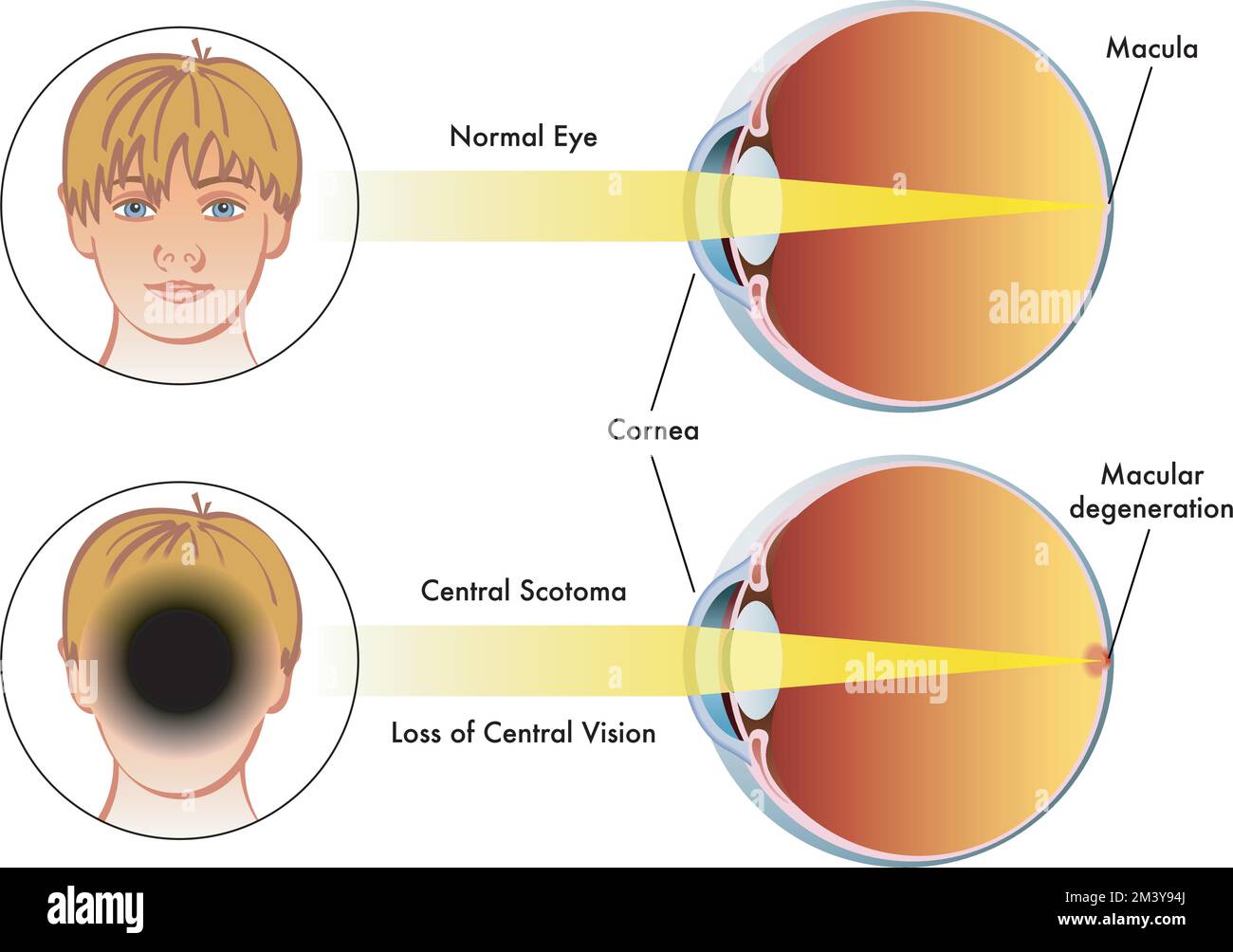 Illustration médicale comparer un œil humain avec un scotome central, avec un œil normal. Illustration de Vecteur