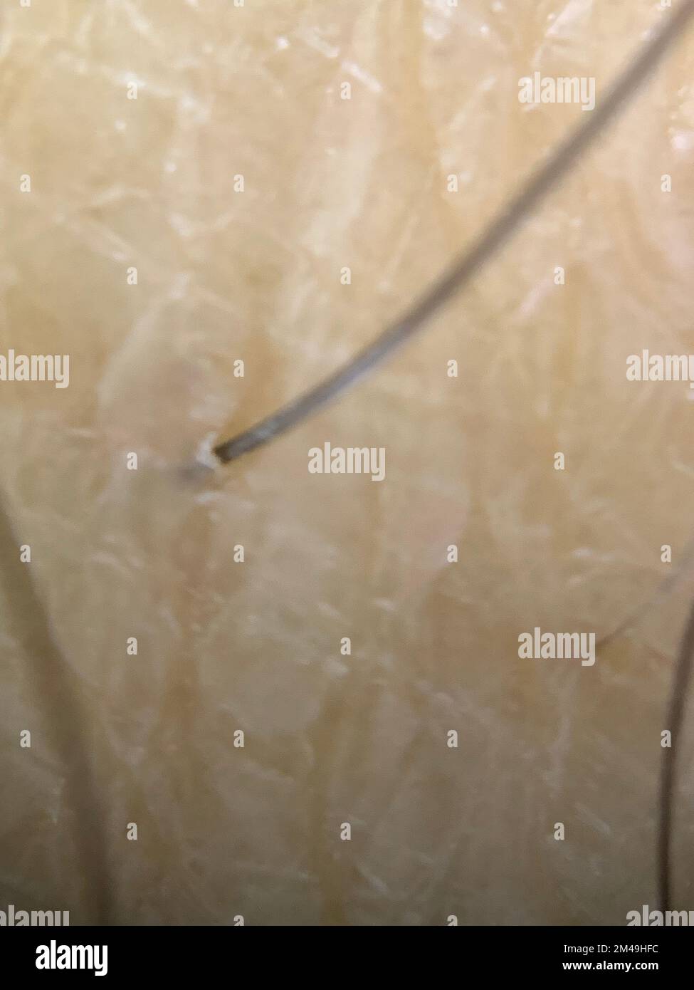 Concept de la calvitie héréditaire alopécie androgénétique et 5-alpha réductase: Gros plan d'un cheveu humain sortant de l'épiderme. transplanté Banque D'Images