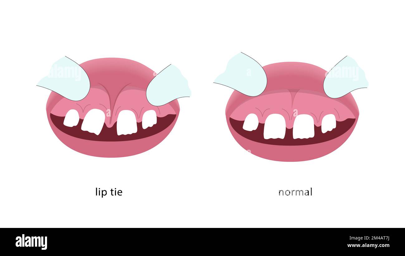 Illustration du lien à lèvres avant et après l'intervention chirurgicale. Illustration de Vecteur