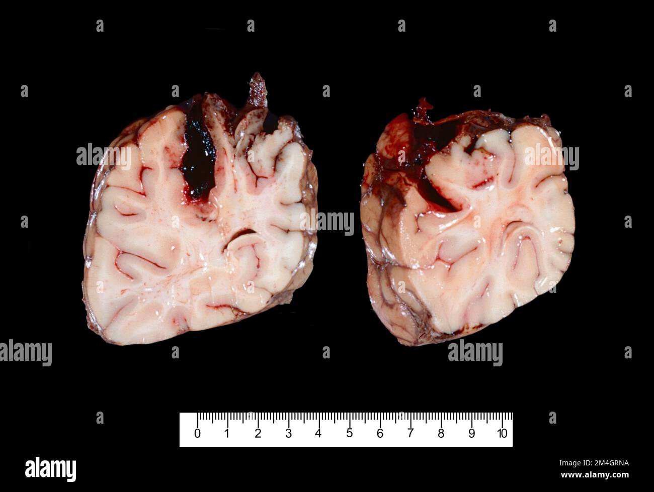 Spécimen brut montrant deux coupes de cerveau du lobe frontal montrant une hémorragie intraparenchymateuse. L'hypertension est la cause la plus fréquente de ce t Banque D'Images