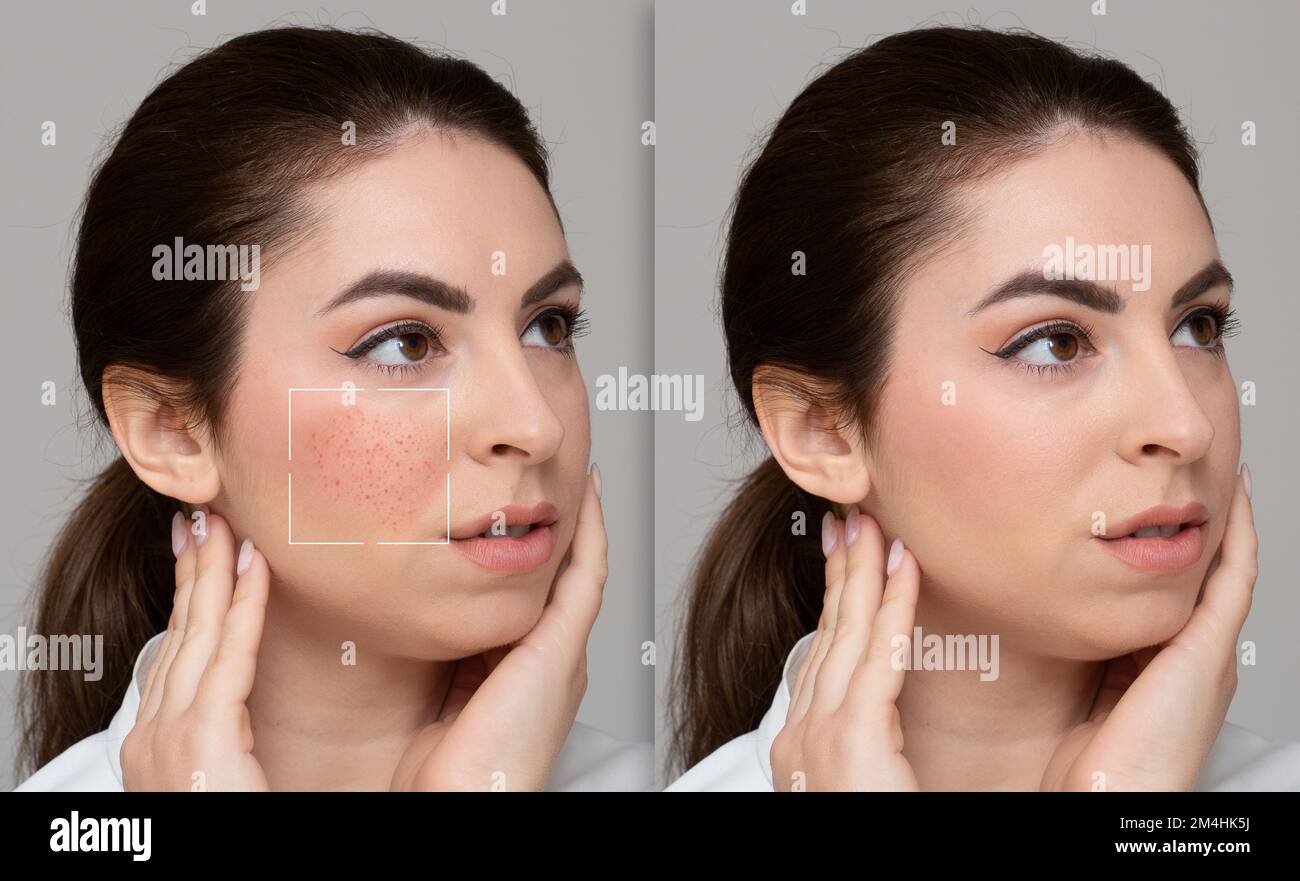 Avant et après le traitement acneiform rosacée. Joue à bouton rouge d'une fille avec un coupé. Concept de soins de la peau et de dermatologie Banque D'Images