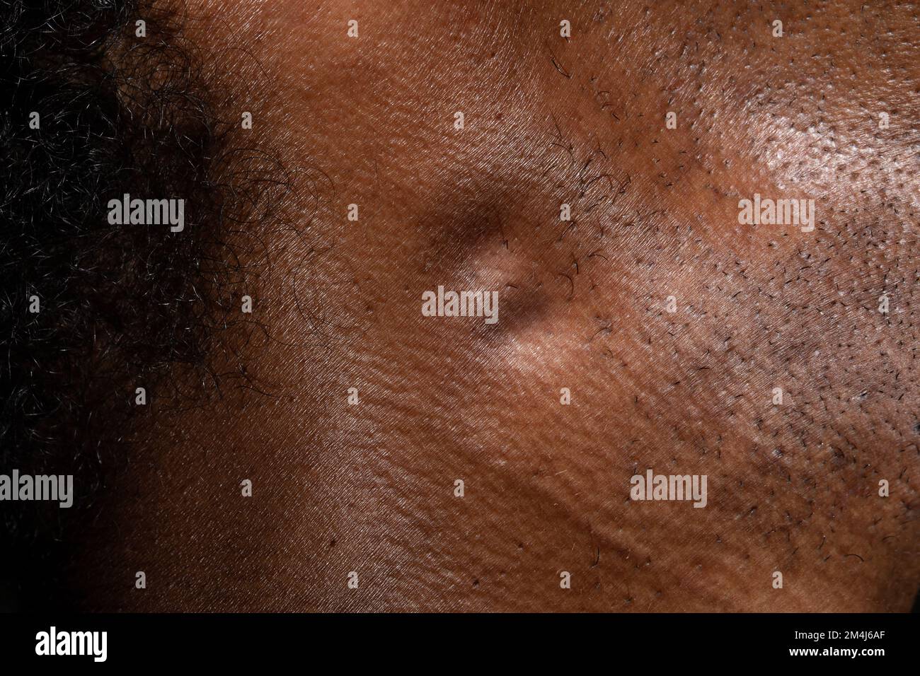 Macro des ganglions lymphatiques enflés dans le cou d'un homme africain ...