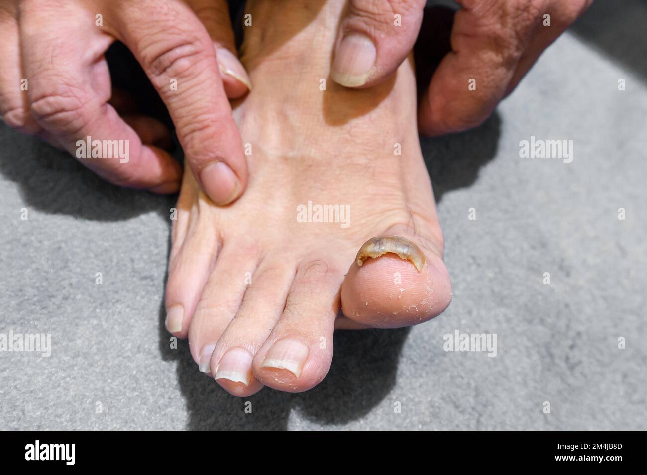 Une vue rapprochée d'un homme pieds nus avec un gros ongle jaune et épais,  onychomycose, une infection fongique des ongles d'orteil Photo Stock - Alamy