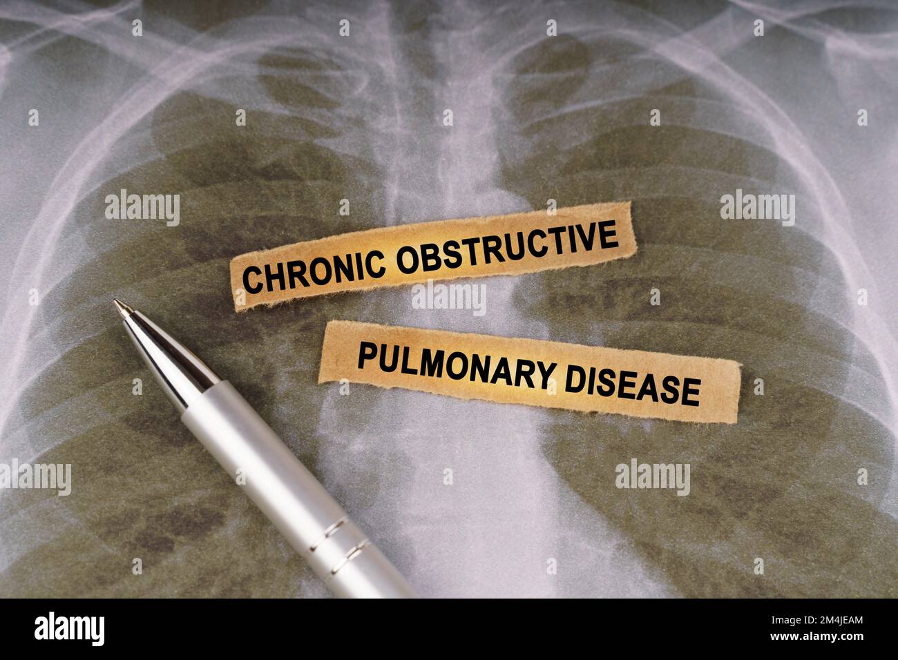 Concept médical. Sur une radiographie thoracique humaine, un stylo et des bandes de papier étiquetés - MALADIE PULMONAIRE OBSTRUCTIVE CHRONIQUE Banque D'Images