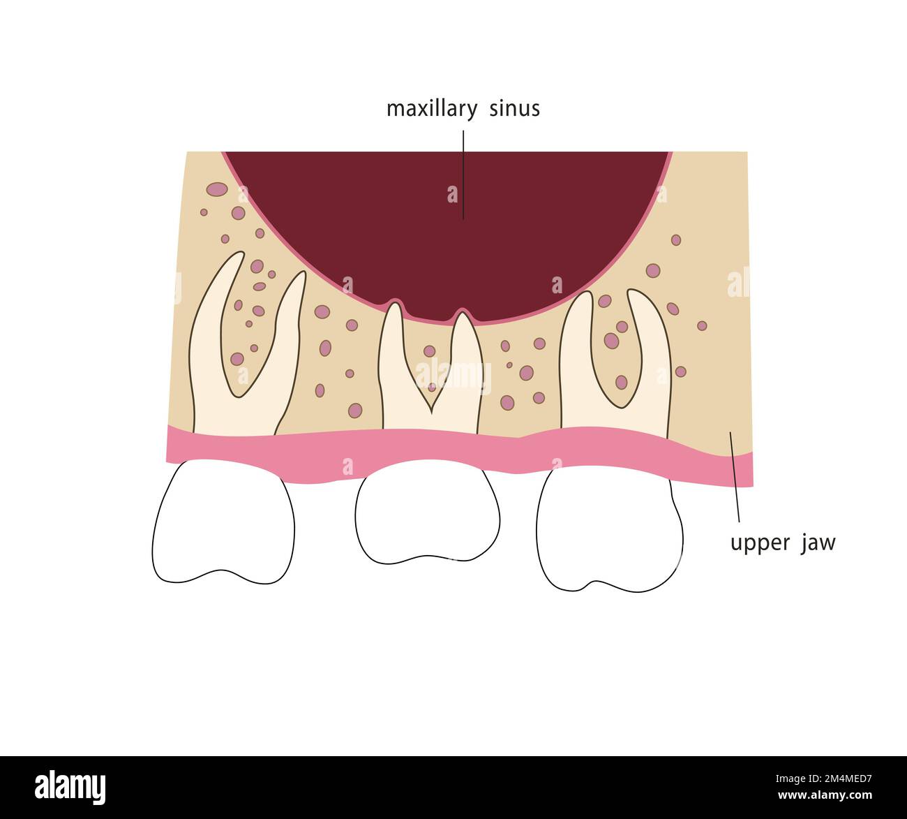 Racines dentaires dans le sinus maxillaire. Illustration médicale de style plat. Illustration de Vecteur