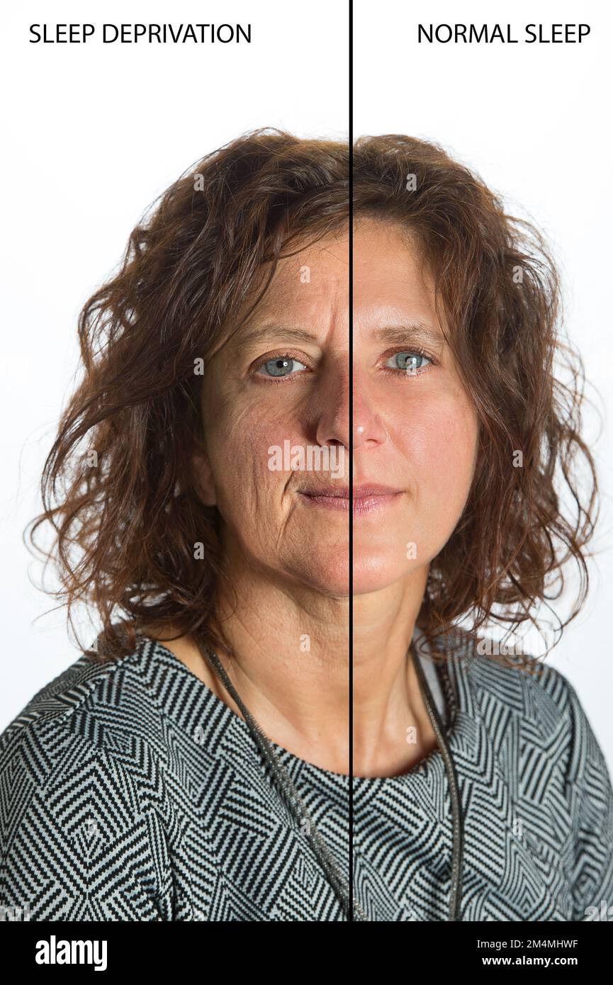 Effets de la privation de sommeil sur le visage d'une femme, comparaison avant et après la privation de sommeil et le repos normal Banque D'Images