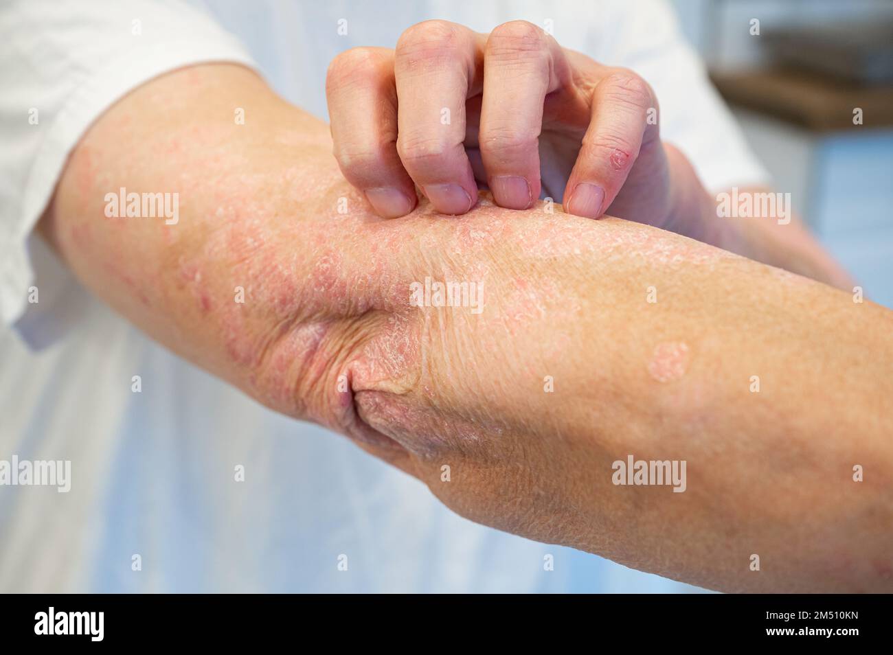 Psoriasis en démangeaisons sur le bras et la main Banque D'Images Psoriasis en démangeaisons sur le bras et la main Banque D'Images