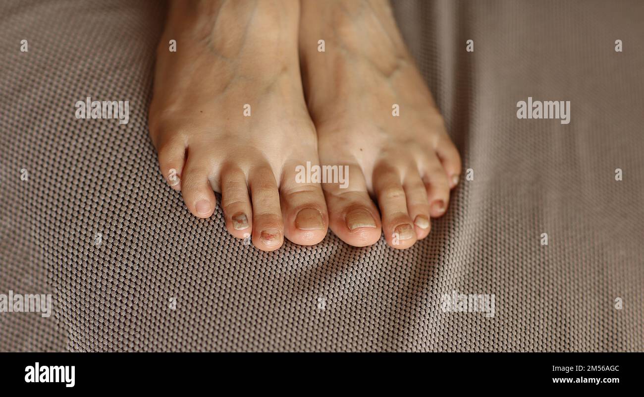 Les pieds de la personne avec un hématome subungual, les ongles du pied noirs causés par un