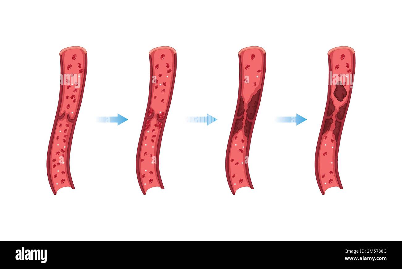 Conception scientifique de veine variqueuse. Symboles colorés. Illustration vectorielle. Illustration de Vecteur
