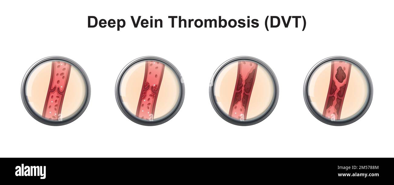 Conception scientifique de veine variqueuse. Symboles colorés. Illustration vectorielle. Illustration de Vecteur