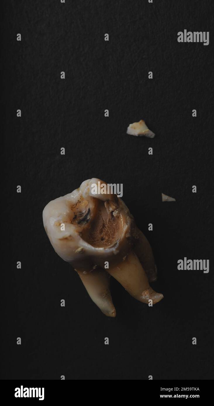 Carie dentaire sur fond noir. Photo macro d'une dent décalées jusqu'à la racine après l'extraction du dentiste. Anatomie réelle des dents en raison d'un manque de soin. Vue de dessus de Banque D'Images